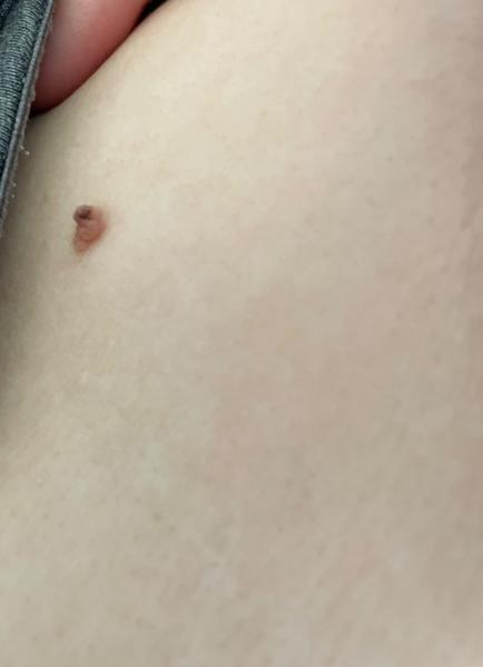 Tmavé znamienko na koži