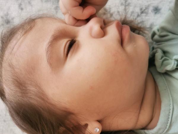 Môže mať dieťa vyrážky na tváričke zo zubov?