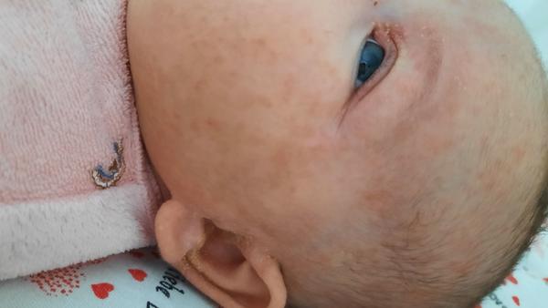 Dvojmesačné bábätko má vyrážky a tečie mu z uška