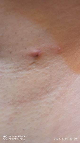 Ako liečiť vyrážku pod pazuchou? Príčiny a tipy.