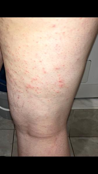 Aké sú toto vyrážky?