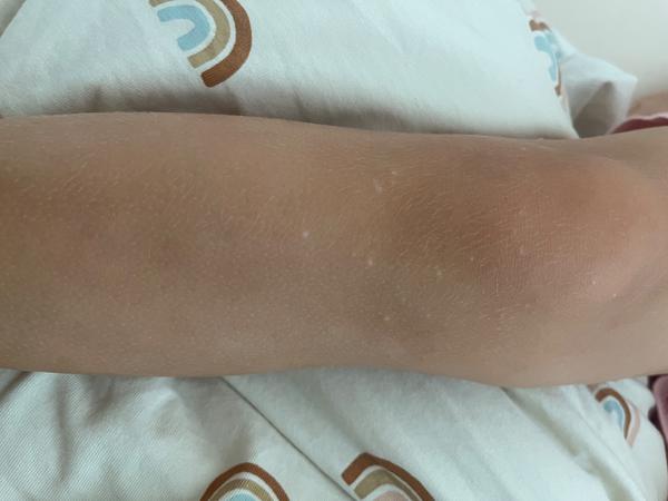 Vyrážky u 3-ročného dieťaťa