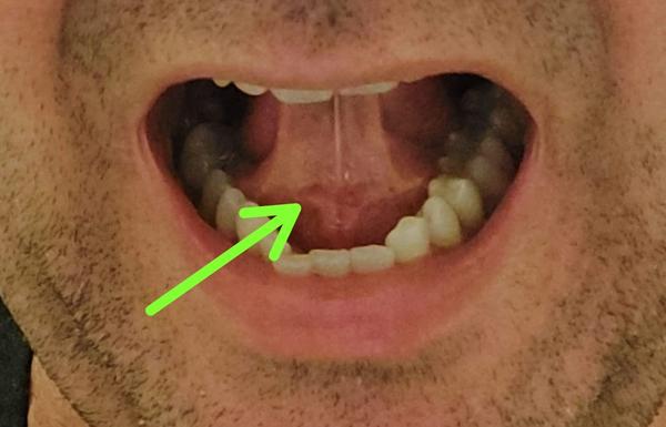 Mám ísť k lekárovi s útvarom, ktorý sa mi vytvoril vedľa slinnej žľazy?