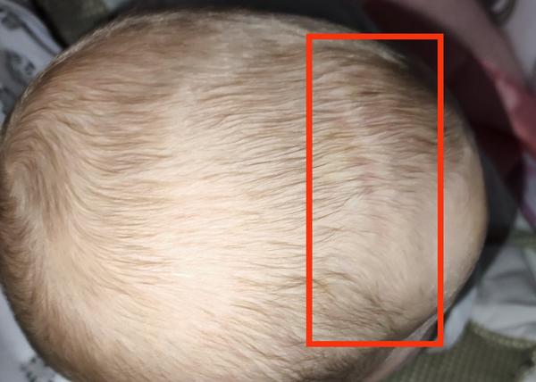 Zmizne dcérke z hlavičky preliačina po otlačení postieľkou?