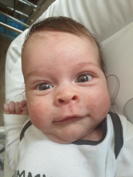 Červené pupáky na líčkach syna