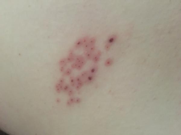 Aké sú toto vyrážky?