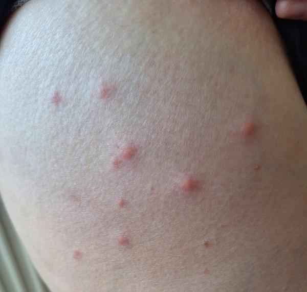 Ako rozpoznať štípance od ploštice?