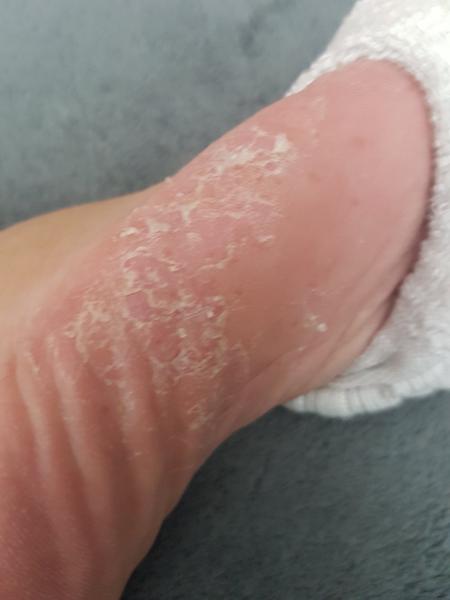 Ako sa zbaviť problémov s pokožkou?