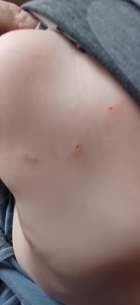 Prečo má syn zvláštne štípance?