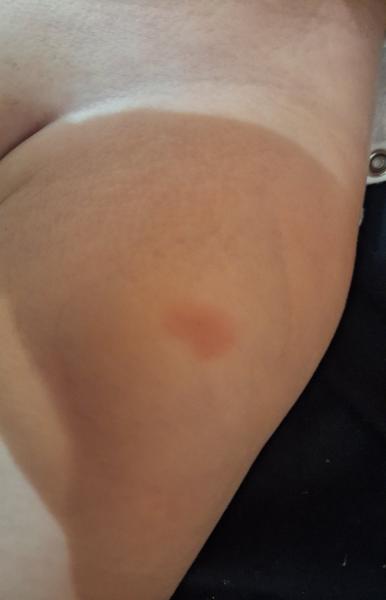 Ako riešiť fľak po očkovaní u detí?