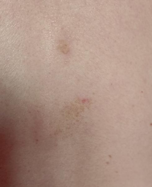 Čo to mám na koži?