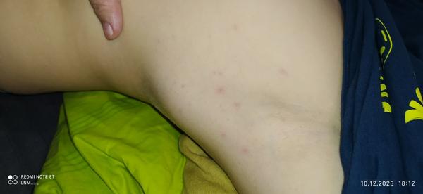 Čo spôsobuje výsev vyrážok?