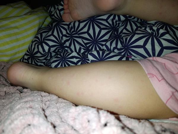 Môžu vyrážky na nohe znamenať kiahne?