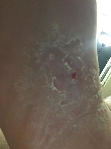 Ako liečiť suchú a svrbiacu klenbu nôh?