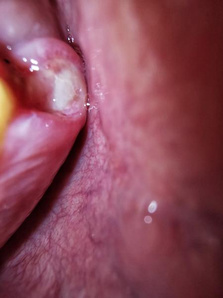 Je normálne, že po každej injekcii u zubárky ma najviac trápi vpich po injekcii?