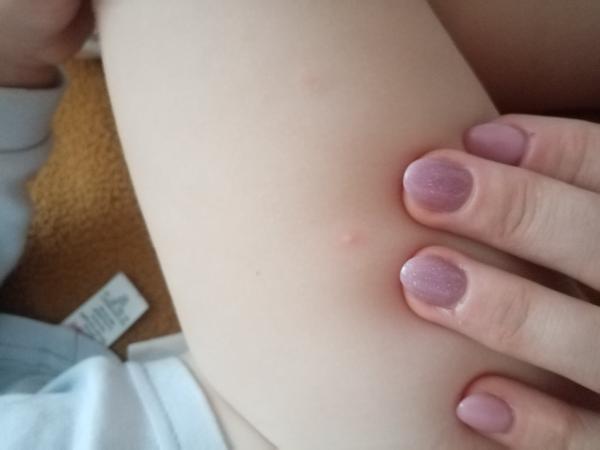 Má moje dieťa kiahne?