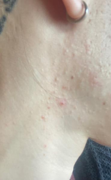 Čo spôsobuje vznik podkožného akné?