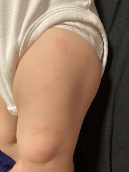 Mliečna kaša - alergia