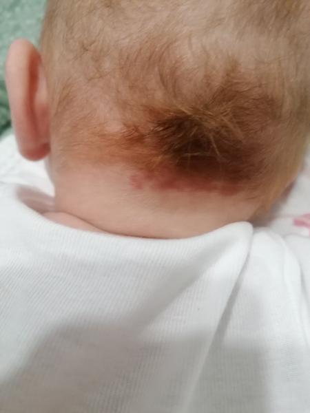 Dcérka má vzadu na krku červené fľaky