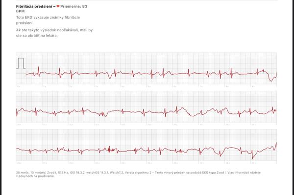 Extrasystoly a fibrilácia predsiení