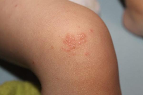 Aký kožný problém je toto?