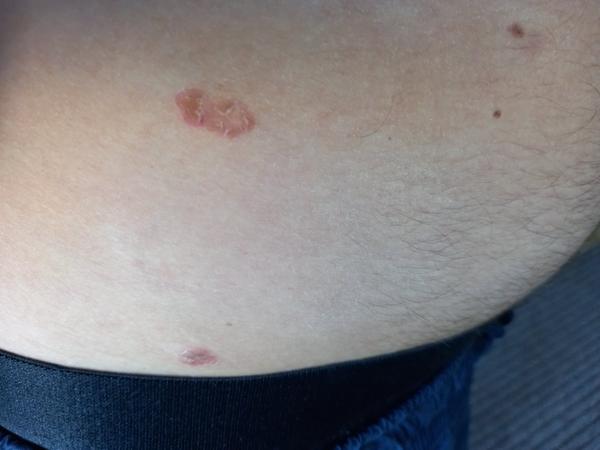 Na tele sa mi robia fľaky