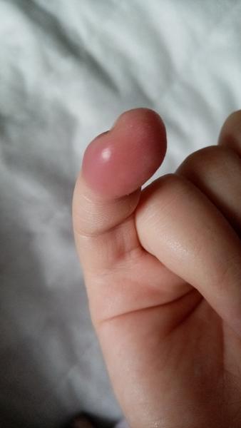 Opuchnutý malíček