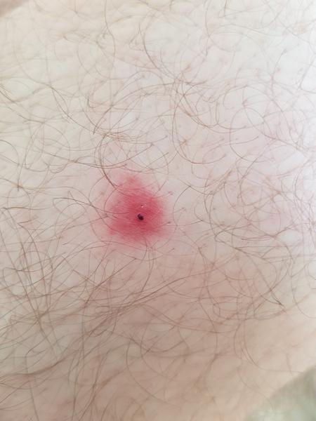 Čo by to mohlo byť? Svrbiaci fľak, ale nevieme z čoho