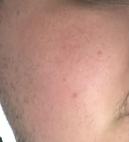 Domáce recepty na zmiernenie začervenanej tváre