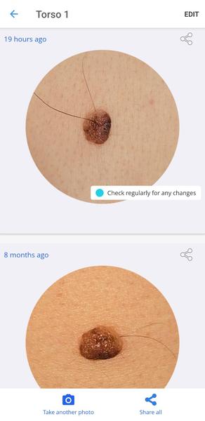 Moje znamienko bolí pri dotyku. Čo robiť?