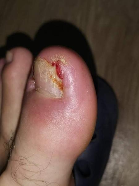 Hnisavý necht u partnera