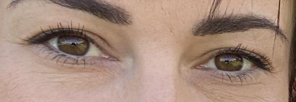 Som už adept na operáciu horných viečok?