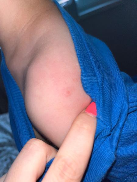 Vyrážka u 4-ročného