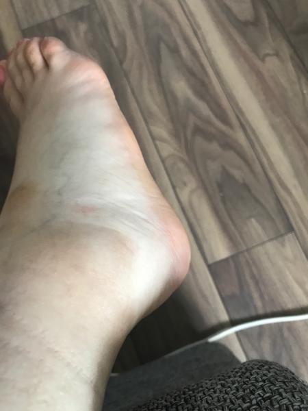 Opuchnuté nohy v 21 týždni