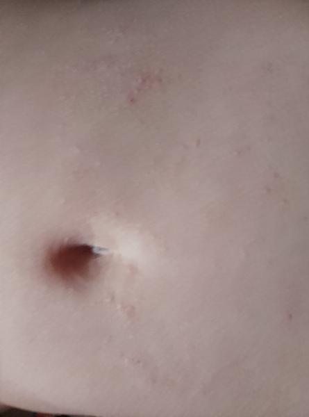 Môže mať dcéra svrab?