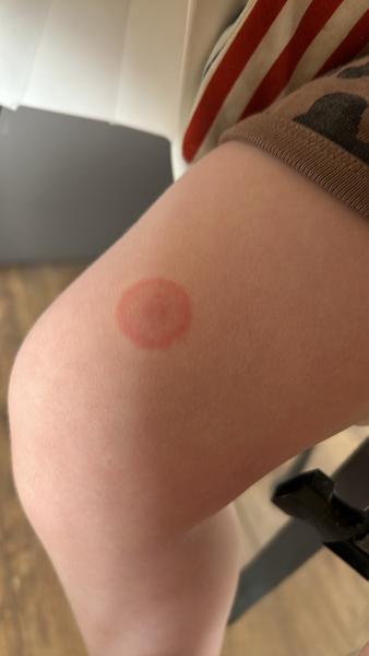 Aký štípanec má dcéra na nohe?