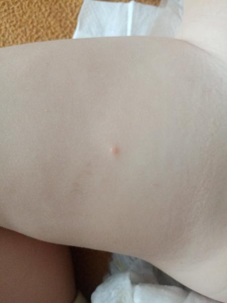 Má moje dieťa kiahne?