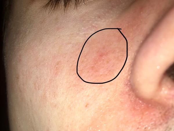 Z čoho mám zväčšenú cievu pri nose?