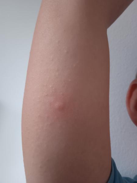 Kedy po nakazení kliešťom ísť na krv?