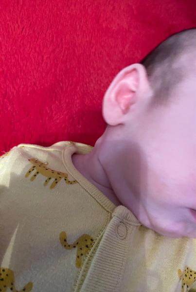 Hrčka na krku trojmesačného syna: Skúsenosti rodičov?