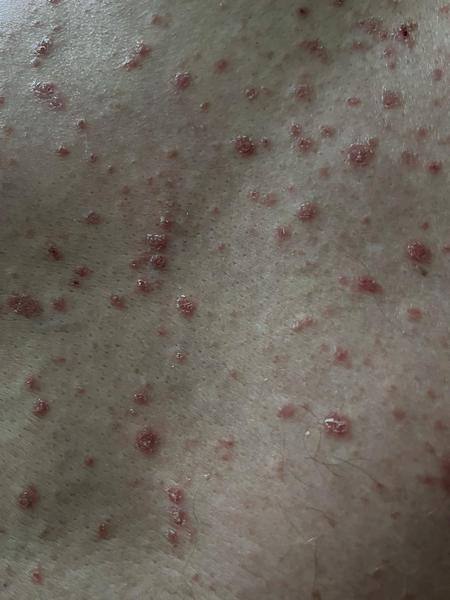 Vyrážky bez svrbenia a nezlepšenie po liekoch