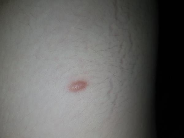 Čudné výrastky - kožný problém