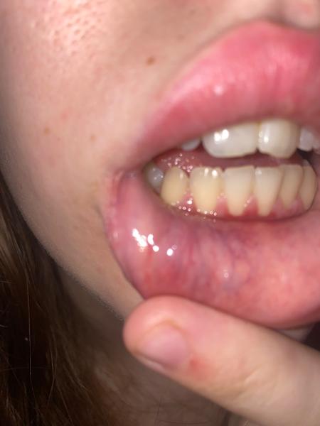 Hrčka na spodnej pere