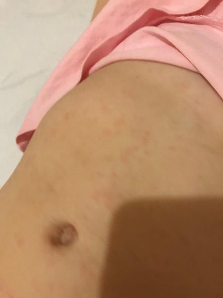 Z čoho môže vzniknúť kožný výsyp?