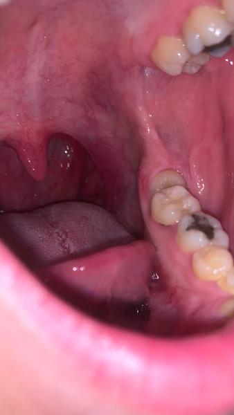 Je to kvapavka v hrdle?