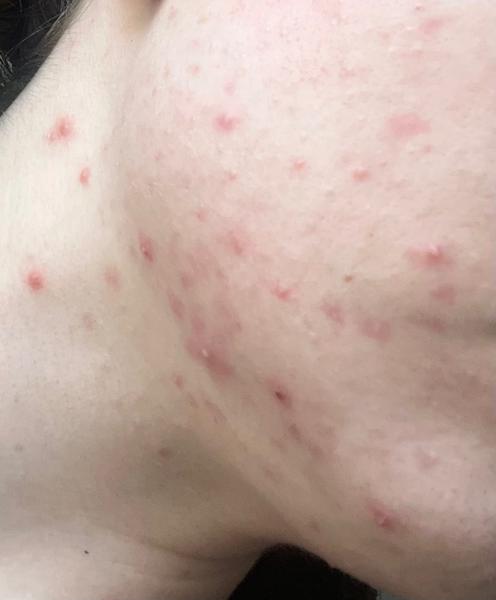 Ako sa zbaviť akné?