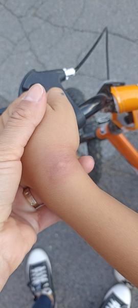 Z čoho môže byť takýto štípanec?