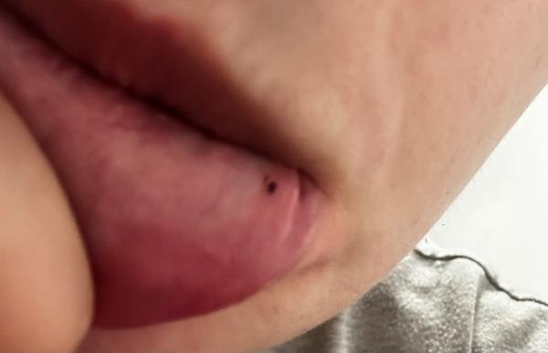 Krvavo fialové bodky na pere – čo znamenajú?