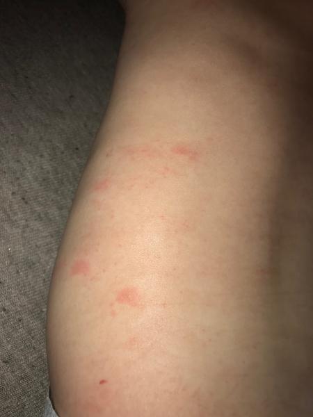 Aký kožný problém má moja 6 mesačná dcérka na chrbátiku?