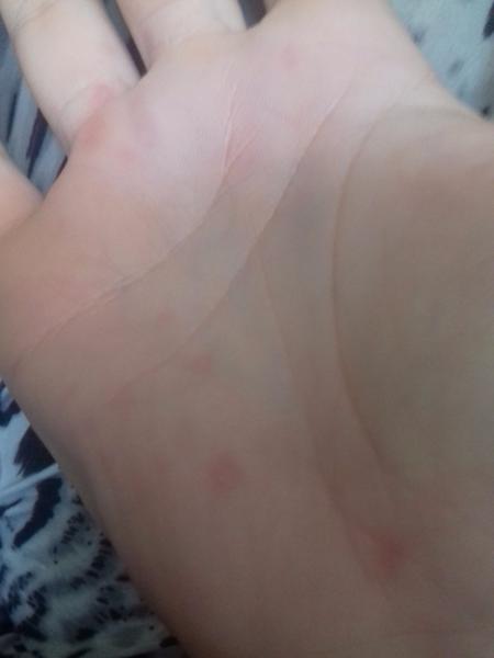 Červené bolestivé škvrny na dlaniach počas tehu